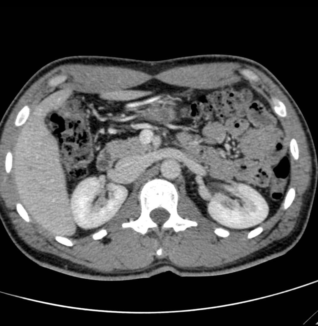 1: Aorta abdominalis 2: V. cava inferior 3: V.
