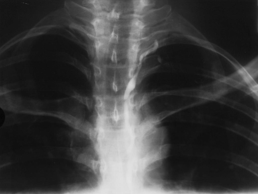 Røntgenbillede af en lymfografi: Røntgenkontrast er sprøjtet ind i et lymfekar på fodryggen.