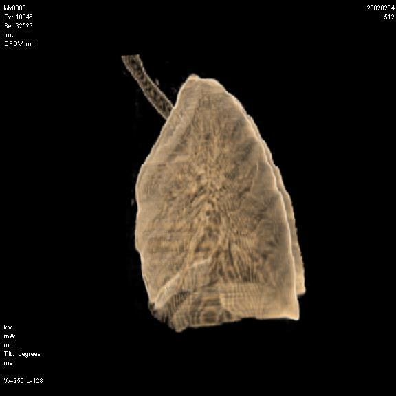 Lungernes topografi og relationer : CT 3D Apex pulmonis. Basis pulmonis.