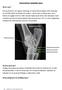 Osteoarthritis i haseleddet (spat)