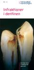 Infraktioner i dentinen