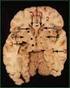 Hjernens basale hjerneganglier og lateral ventrikler
